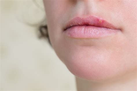 Bumps On Lips Common Causes And Treatment Tips