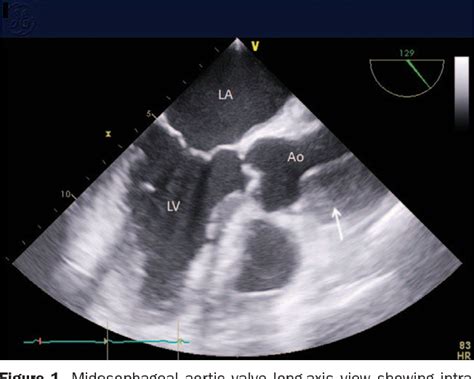 Figure 2 From Retrograde Type A Aortic Dissection After