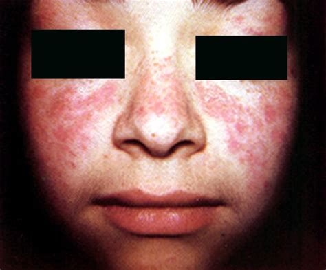👉 Systemic Lupus Erythematosus Pictures Symptoms Causes Treatment