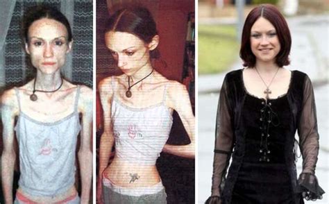 10 antes e depois de pessoas que venceram a anorexia