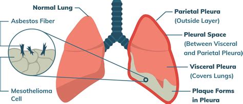 Check spelling or type a new query. Mesothelioma Treatment Types and Guidelines