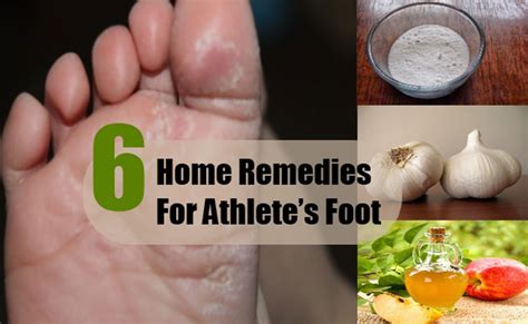 6 Homemade Remedies To Treat Athletes Foot Daily Health Valley