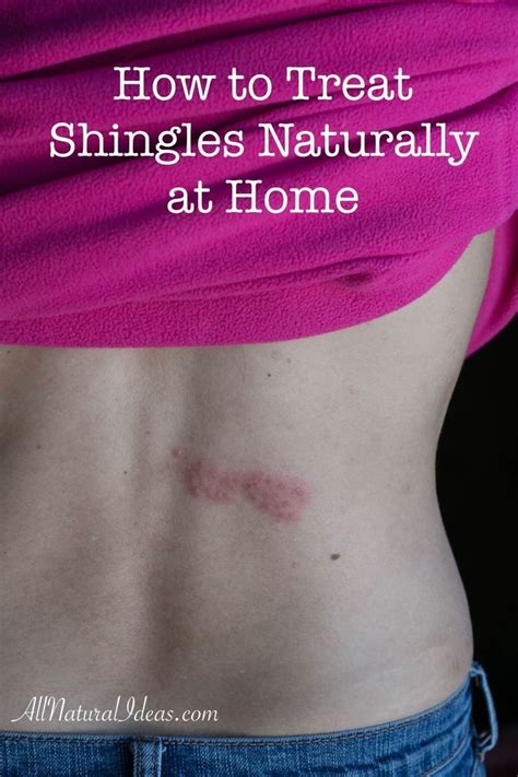 Treat Shingles Naturally At Home Shingles Treatment Treating