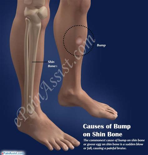 Causes Symptoms Of Bump On Shin Bone And Its Natural Remedies