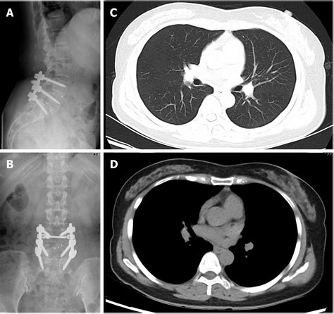 Chylothorax Following Posterior Low Lumbar Fusion Surgery A Case Report