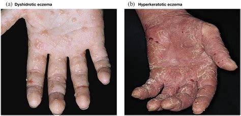 Most Common Phenotypes Of Hand Eczema Dyshidrotic And Download