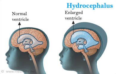Anatomy Of The Brain Hydrocephalus