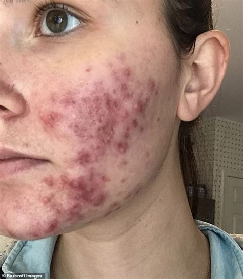 Stylist 23 With Severe Cystic Acne Goes Out Without Makeup For The First Time Daily Mail Online