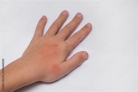 Red Spots On Child Hands Skin Covered With Moisture Cream The Cause Is