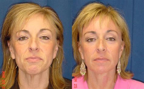 Face Lift Brow Lift Mid Facelift Lower Facelift Before And After