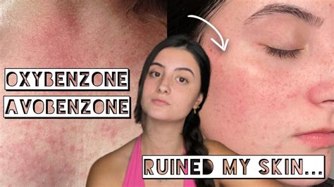 A Sunscreen Gave Me An Allergic Reactioncontact Dermatitis Lets