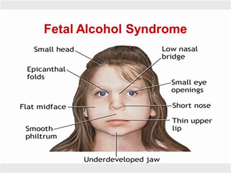 adults with fetal alcohol syndrome
