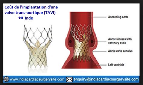 Implantation De La Valve Aortique Par Cathéter Coût Tavi En Inde Le