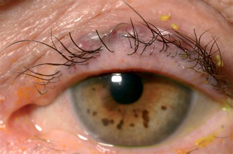 Trichiasis Ingrown Eyelash Causes Symptoms And Treatment
