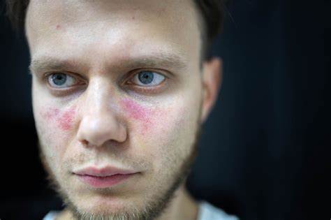 Диета системная красная волчанка Красная Системная Волчанка Картинки – Telegraph Красная Системная Волчанка Картинки – Telegraph Диета системная красная волчанка