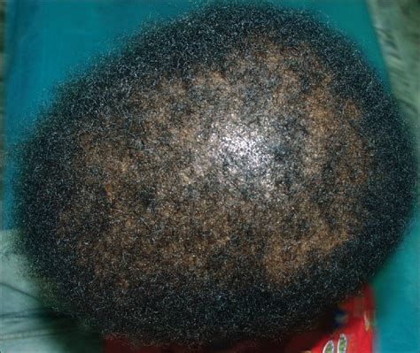Naxos Disease A Rare Occurrence Of Cardiomyopathy With Woolly Hair And Palmoplantar Keratoderma