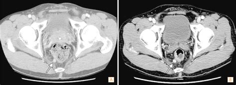Abdominopelvic Ct Findings A The Initial Ct Imaging Showed
