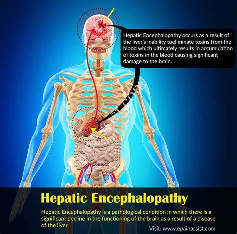 Hepatic Encephalopathy Causes Symptoms Treatment Prognosis Prevention