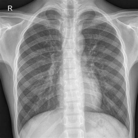 Covid 19 Kaggle Chest X Ray Normal Qmenta