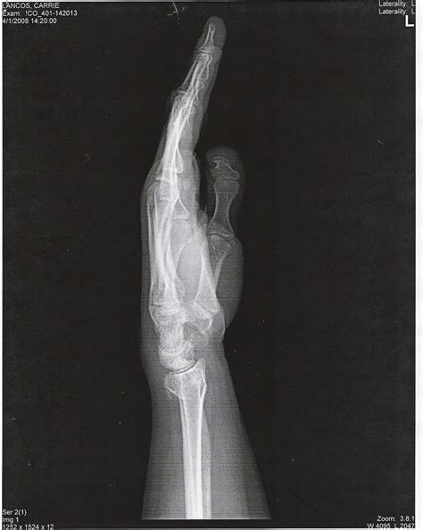 Wrist X Ray 2 Side View Of My Broken Left Wrist Taken