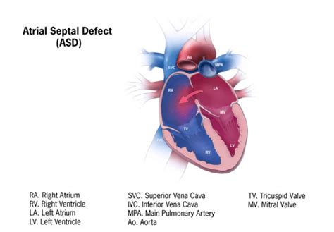 Atrial Septal Defect Asd Child Heart Specialist
