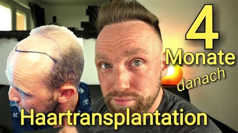 Haartransplantation Barthaare Auf Kopf Transplantiert 4 Monate Danach