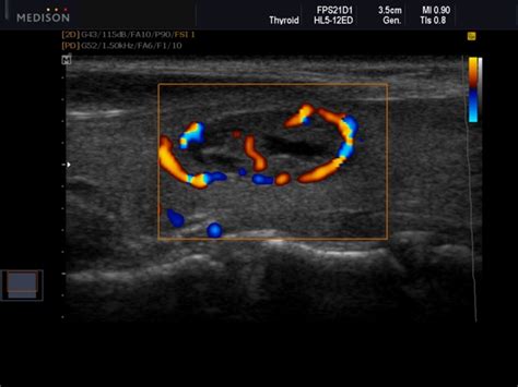 An ultrasound scan of your neck can check for a lump in your if a biopsy finds that you have thyroid cancer, further tests may be needed to check whether the cancer had spread to another part of your body. Ultrasound images - Thyroid, nodule, DPDI (№553, SonoAce-R7)