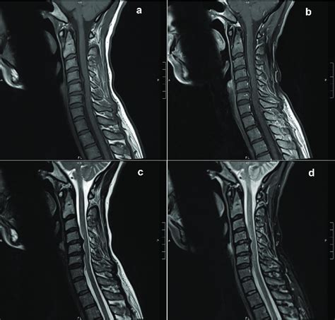 Mri Of The Cervical Spine With And Without Contrast Showing Multilevel