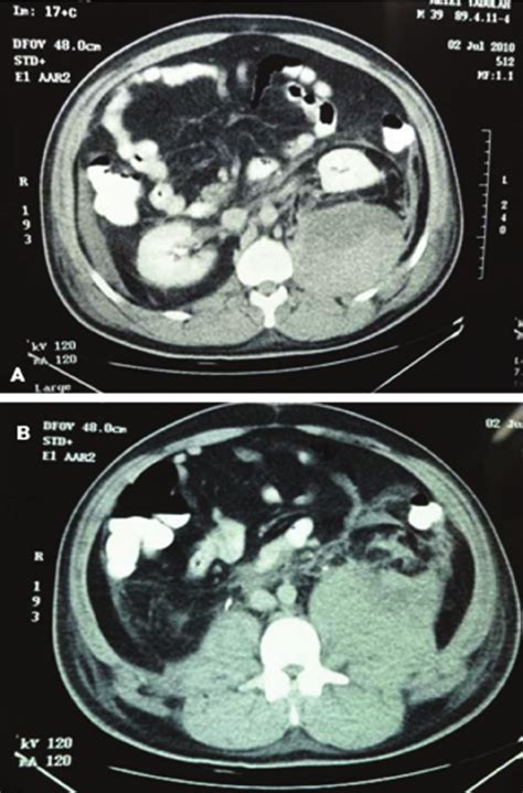 Ab Sections Of Enhanced Ct Scan Of Abdomen Showing 9 × 12 Cm
