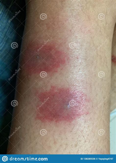 Blisters Redness Impetigo At The Skin Area Legs Of Women Allergic