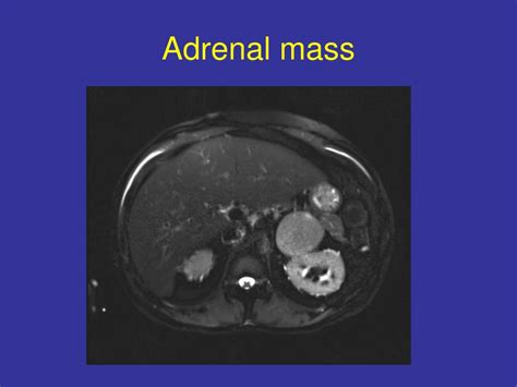 Ppt Adrenal Mass Powerpoint Presentation Free Download Id5144325