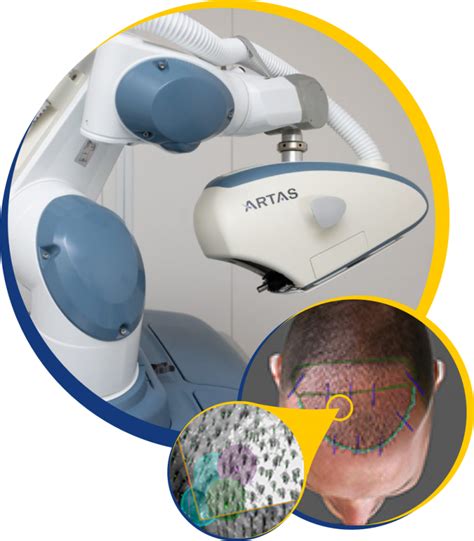 Artas Hair Transplant Robot The Knudsen Clinic