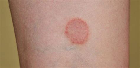 What Does It Mean If You Have These Rashes Tiphero