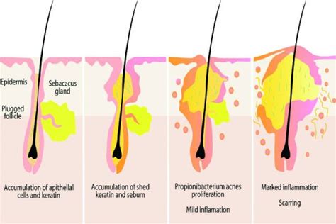 Oily Scalp Is There A Solution After All