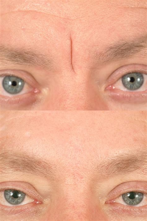 Scar Revision Before And After Photos Dr Benjamin Bassichis