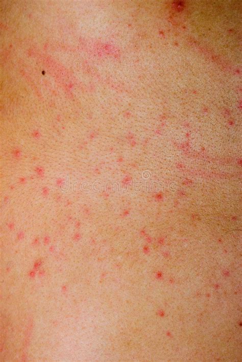 Allergic Rash Dermatitis Skin Stock Image Image Of Dermatitis