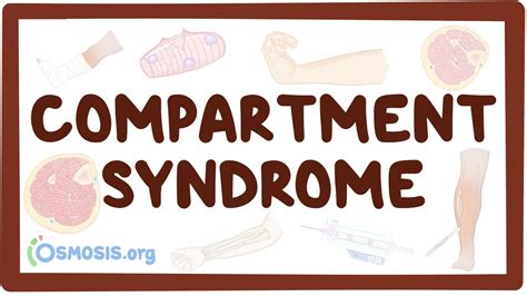 Compartment Syndrome Video Anatomy And Definition Osmosis