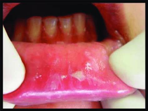 Diffuse Irregular White Area Of Lower Lip Due To Chronic Biting
