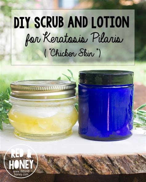 Healthy Children Diy Scrub And Lotion For Keratosis Pilaris “chicken