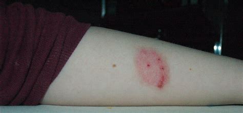 What Are The Most Commonest Spider Bites Symptoms With Pictures