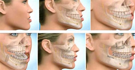Maxillofacial Surgery Everything You Need To Know