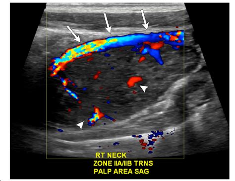 Color Doppler Ultrasound Image Of The Right Cervical Neck Demonstrates