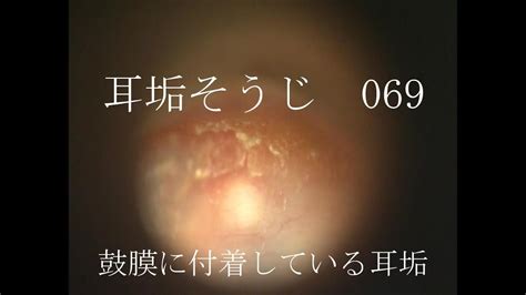耳垢そうじ/耳が痒い鼓膜に付着した耳垢/069 - YouTube