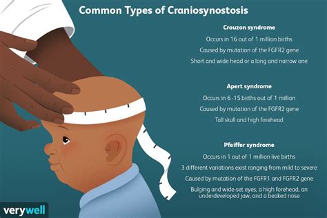 Craniosynostosis Syndromes Types Definitions And More