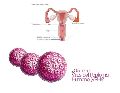 VIRUS DEL PAPILOMA HUMANO VPH Blog Optica Lacalle