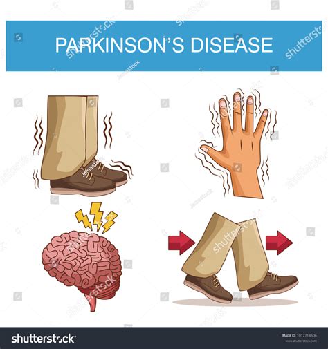 Parkinsons Disease Infographic Stock Vector Royalty Free 1012714606