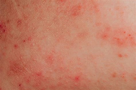 Skin Rashes That Itch Pin On Skin Rash Frequent Use Of Moisturizing Creams And Oil Baths