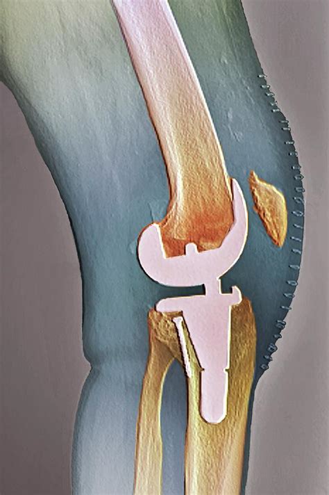 Total Knee Replacement Photograph By Zephyrscience Photo Library Pixels