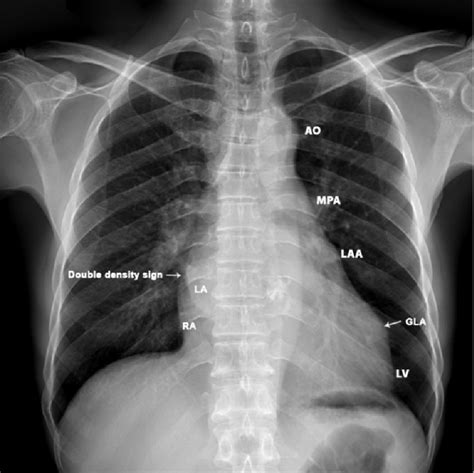 X Ray Chest Pa Postero Anterior View Showing The 4 Bump Left Heart