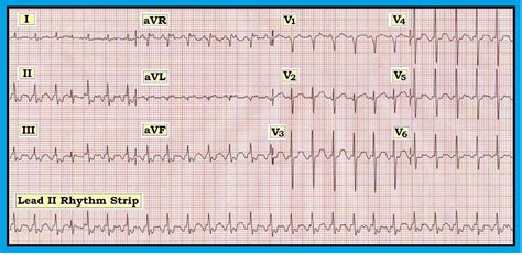 Definition of paroxysmal supraventricular tachyarrhythmia (psvt). ECG Interpretation: ECG Interpretation Review #40 (Regular ...